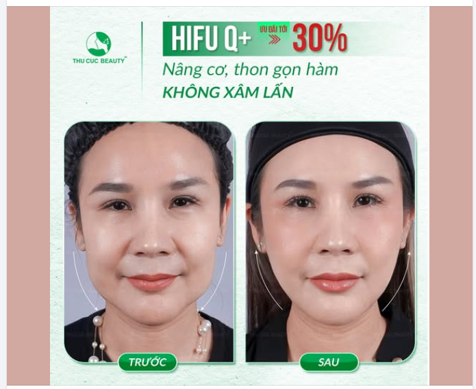 TÁI ĐỊNH HÌNH VIỀN HÀM CHẢY XỆ - ĐIÊU KHẮC ĐƯỜNG NÉT V-LINE THANH TÚ VỚI HIFU Q+: