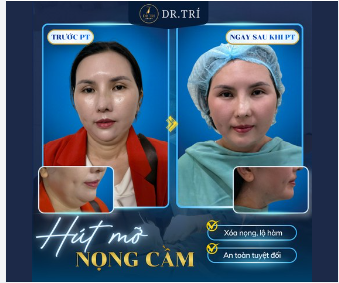 XÓA TAN NỌNG CẰM- TÁI TẠO ĐƯỜNG NÉT THON GỌN