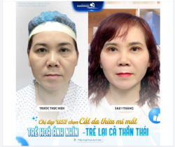 Ở tuổi trung niên, sự thay đổi rõ rệt nhất thường không nằm ở nếp nhăn nơi khóe miệng, mà chính là đôi mắt.