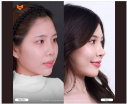 DÁNG MŨI ĐẸP LÀ KHI LÀM XONG, GƯƠNG MẶT VẪN HÀI HÒA NHƯ CHÍNH MÌNH