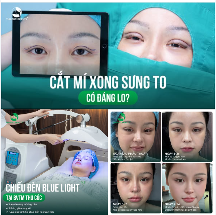 CẮT MÍ XONG SƯNG TO - CÓ ĐÁNG LO?