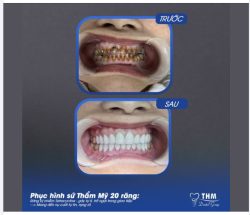 ĐỪNG NHẦM LẪN: Đây KHÔNG phải cao răng!