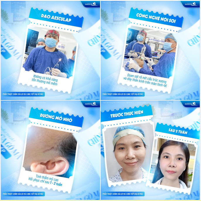 HẠ GÒ MÁ BẰNG CÔNG NGHỆ HIỆN ĐẠI GIÚP HỒI PHỤC NHANH CHÓNG