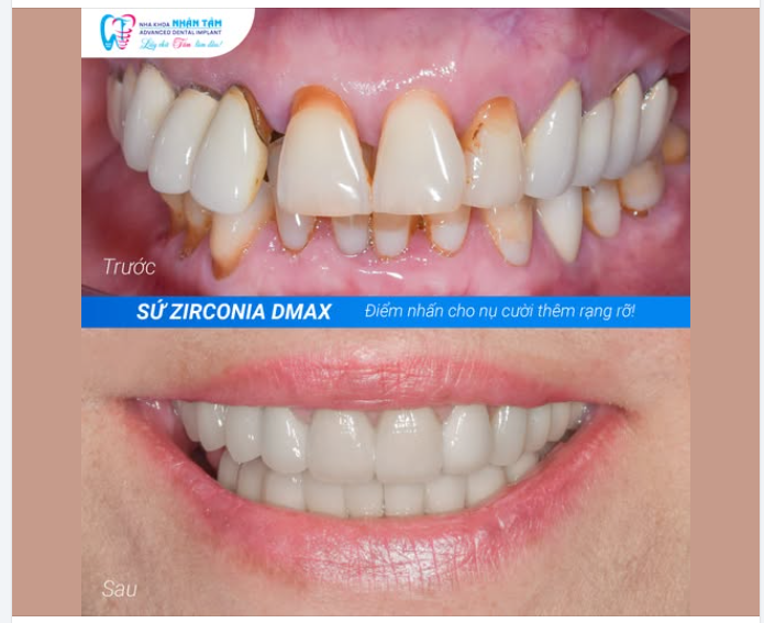 RĂNG SỨ ZIRCONIA DMAX  ĐIỂM NHẤN CHO NỤ CƯỜI RẠNG RỠ