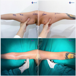 BẮP TAY TO – ÁO ĐẸP CŨNG THÀNH KHÓ MẶC…