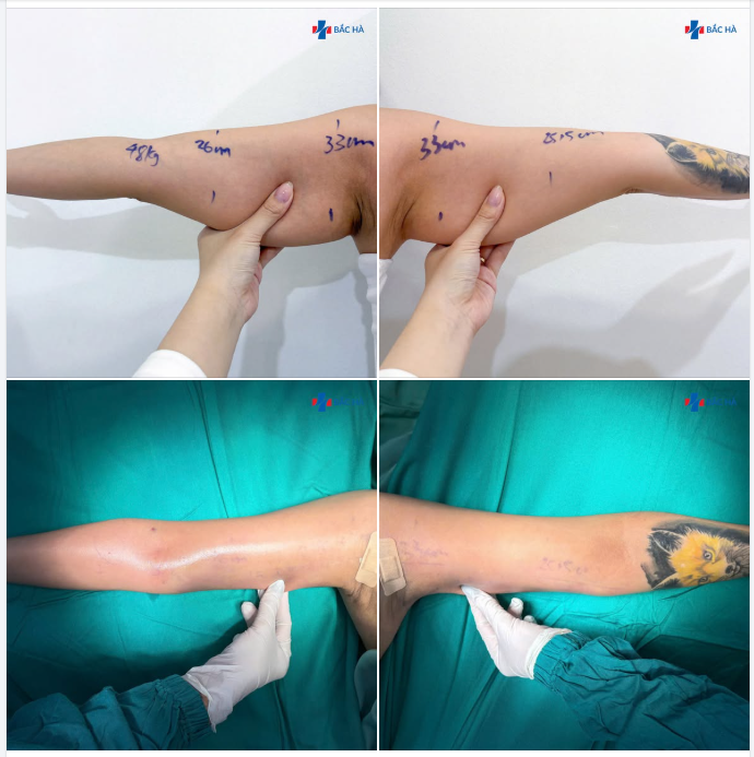 BẮP TAY TO – ÁO ĐẸP CŨNG THÀNH KHÓ MẶC…