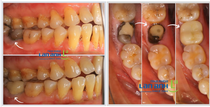 Răng đã chữa tủy – vì sao nên bọc sứ sớm?