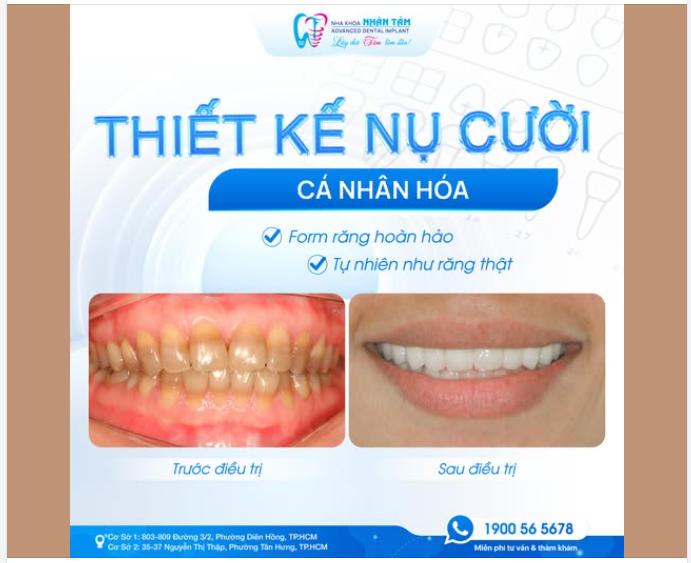 THIẾT KẾ NỤ CƯỜI CÁ NHÂN HÓA - TIÊU CHUẨN CỦA 1 NỤ CƯỜI ĐẸP