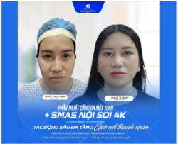 Tại sao các phương pháp căng da thông thường chỉ duy trì được ngắn hạn? Câu trả lời nằm ở "độ sâu" của tác động.