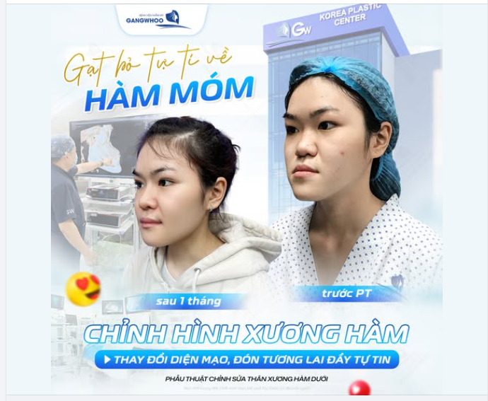 GẠT BỎ TỰ TI VỀ HÀM MÓM