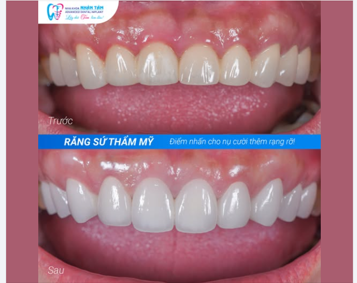 RĂNG SỨ CÁ NHÂN HÓA - THAY ĐỔI NHỎ CHO NỤ CƯỜI THÊM TƯƠI