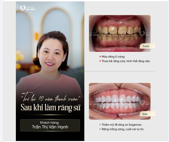 "TRẺ LẠI 10 NĂM THANH XUÂN" SAU KHI LÀM RĂNG SỨ SAGEMAX