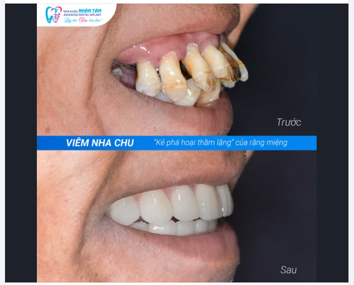VIÊM NHA CHU - “KẺ PHÁ HOẠI THẦM LẶNG” CỦA RĂNG MIỆNG