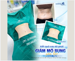 SỬA LẠI BỤNG SAU GIẢM MỠ 2 NĂM