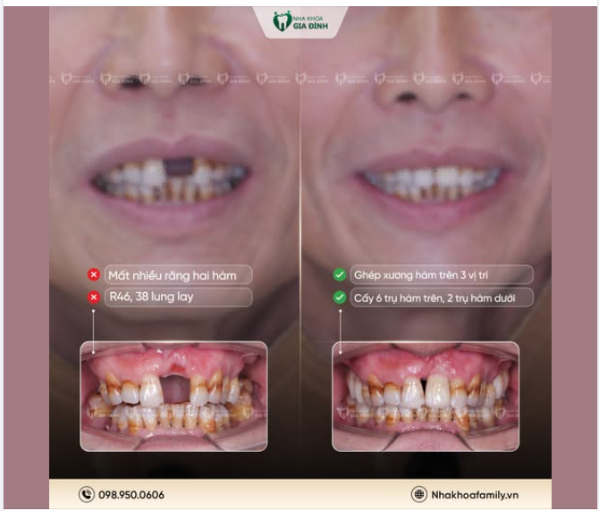Trồng răng implant - Ăn nhai thoải mái, cuộc sống sang trang