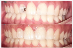 KHẮC PHỤC SÂU RĂNG CỬA - PHỤC HỒI NỤ CƯỜI TỰ NHIÊN