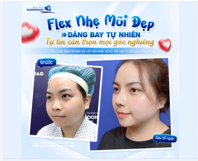 FLEX NHẸ MŨI ĐẸP
