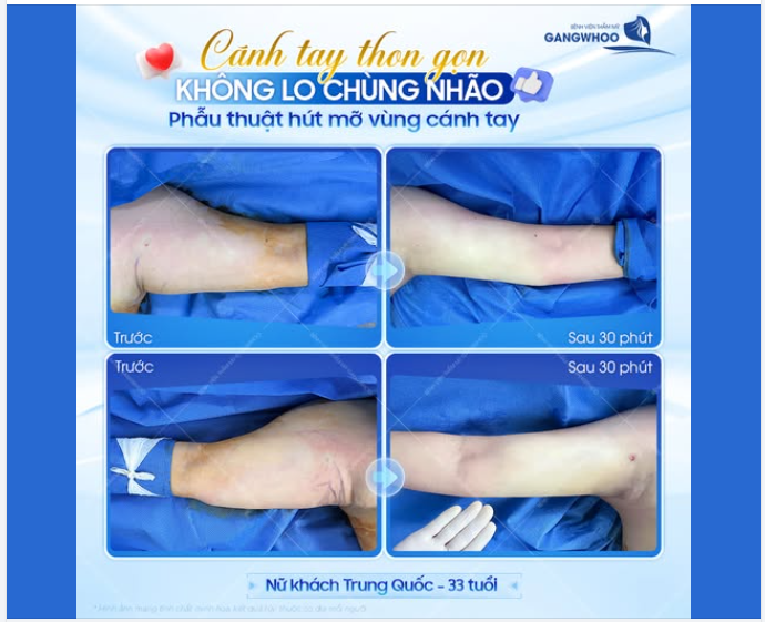 TINH CHỈNH CÁNH TAY – NHẸ NHÀNG HÀI HÒA