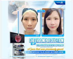 Trường hợp khách hàng người Nhật với đặc điểm gò má cao kết hợp vùng thái dương lõm sâu, khiến tổng thể gương mặt trở nên hốc hác, thiếu sức sống.