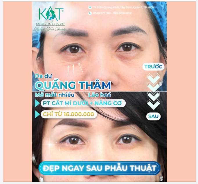 PHẪU THUẬT CẮT MÍ DƯỚI + NÂNG CƠ