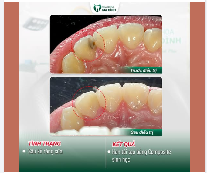 KHẮC PHỤC RĂNG SÂU KẼ CHỈ SAU 1 LẦN HẸN