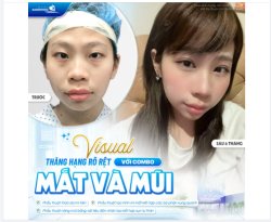 VISUAL THĂNG HẠNG RÕ RỆT VỚI COMBO MẮT MŨI