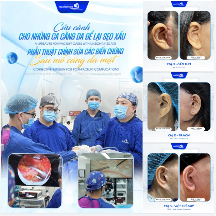 Xử lý sẹo xấu tinh vi: Cắt bỏ mô sẹo cũ, khâu đóng thẩm mỹ theo lớp, giấu kín đường may vào nếp gấp tự nhiên của tai.