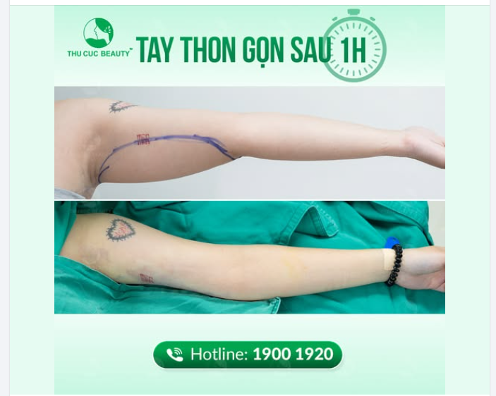 Công nghệ loại bỏ mỡ bắp tay NHANH NHẤT - AN TOÀN NHẤT
