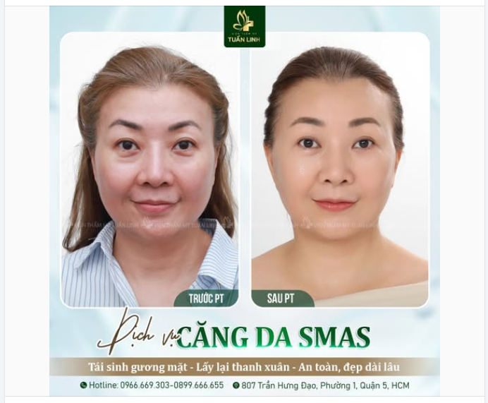 CĂNG DA SMAS – TRẺ HÓA TỪ GỐC, NÂNG CƠ ĐẸP TOÀN DIỆN