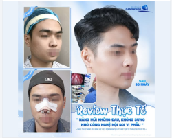 REVIEW THỰC TẾ SAU 30 NGÀY NÂNG MŨI