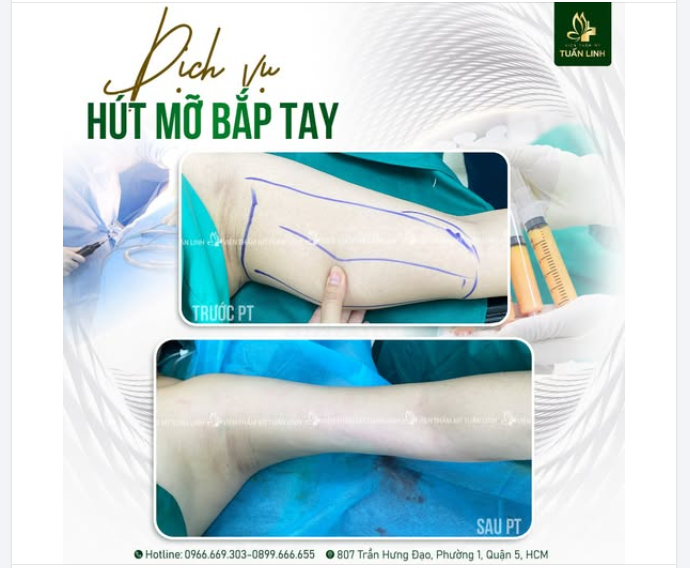 HÚT MỠ BẮP TAY – THON GỌN NHANH, THANH THOÁT, ĐẸP QUYẾN RŨ