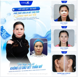 Với phẫu thuật căng da mặt toàn phần + SMAS Nội soi 4K, nỗi lo đó sẽ hoàn toàn biến mất nhờ kỹ thuật "giấu vết" tinh vi, trẻ hóa êm ái - đẹp không dấu vết: