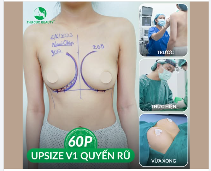 Từ V1 teo lép hóa CẶP TUYẾT LÊ căng tràn