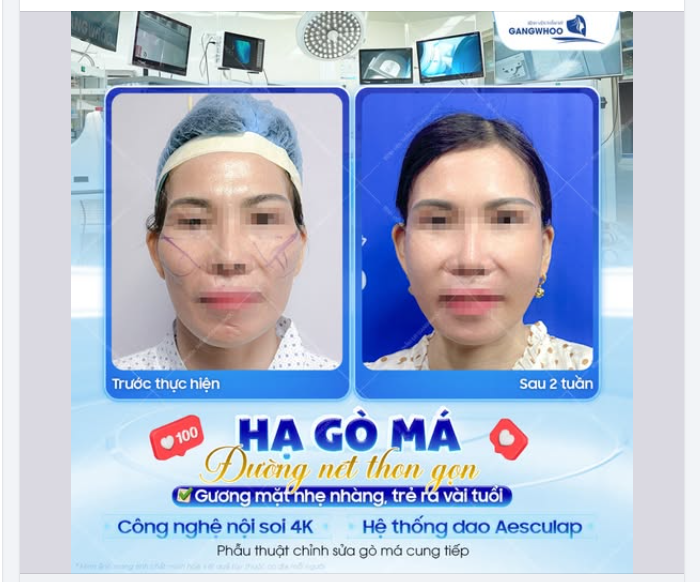 GƯƠNG MẶT THON GỌN – NHẸ NHÀNG TRẺ RA VÀI TUỔI