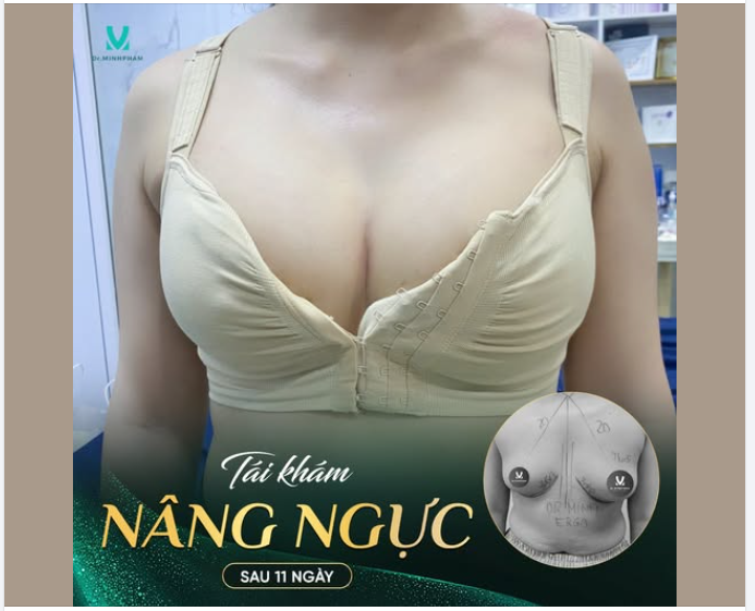 TÁI KHÁM SAU 11 NGÀY NÂNG NGỰC – THAY ĐỔI RÕ RỆT