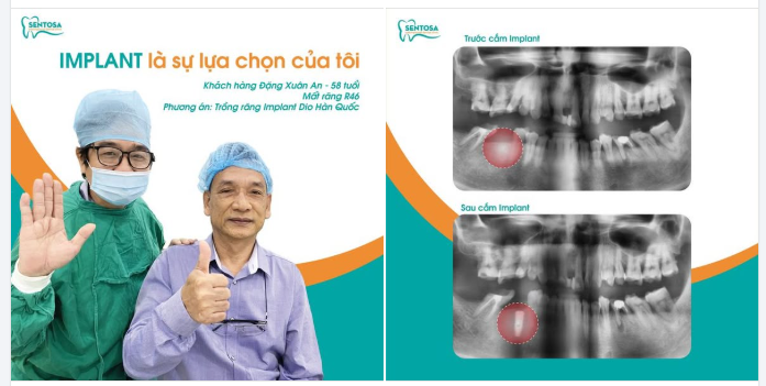 Phục hồi răng mất – Chú Đặng Xuân An an tâm sau khi trồng Implant tại Nha khoa Sentosa