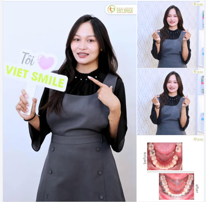 MẤT RĂNG SỐ 6: PHỤC HỒI BẰNG RĂNG THẬT MÀ KHÔNG CẦN IMPLANT?