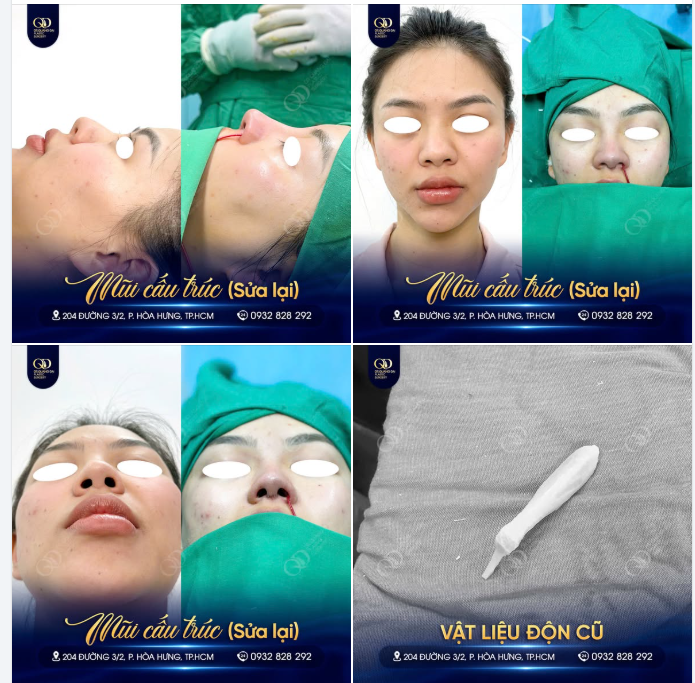 MŨI CẤU TRÚC SỬA LẠI – BÓC BAO XƠ