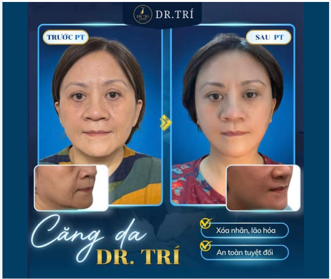 CĂNG DA AN TOÀN – HIỆU QUẢ BỀN VỮNG CÙNG DR. TRÍ