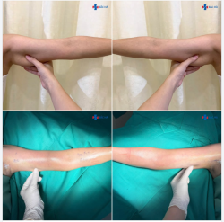 CÓ MỘT VÙNG MỠ… GIẢM CÂN MÃI VẪN KHÔNG HẾT.