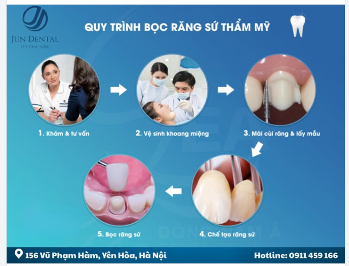 QUY TRÌNH BỌC RĂNG SỨ THẨM MỸ CHUẨN NHA KHOA