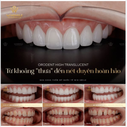 ĐÓNG KHE THƯA RĂNG CỬA BẰNG BỌC SỨ - TÁI LẬP TỶ LỆ CHUẨN XÁC