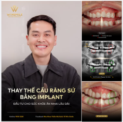 THAY THẾ CẦU RĂNG SỨ BẰNG IMPLANT - ĐẦU TƯ CHO SỨC KHỎE ĂN NHAI LÂU DÀI