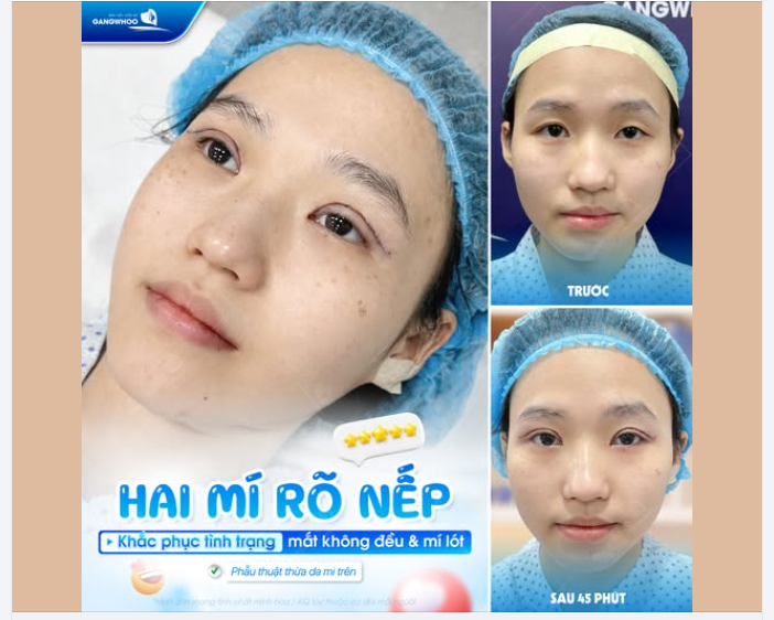 HAI MÍ RÕ NẾP – TẠM BIỆT MẮT KHÔNG ĐỀU MÍ LÓT