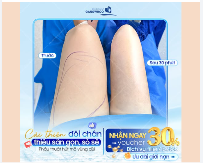 GIẢM MỠ ĐÙI NHẬN VOUCHER HẤP DẪN