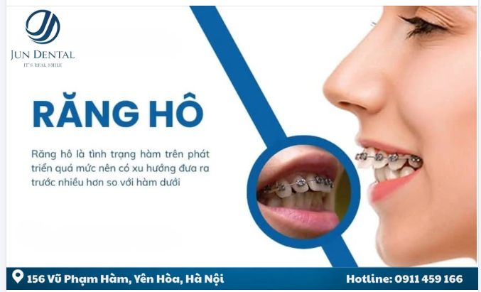 RĂNG HÔ – NGUYÊN NHÂN GIẢI PHÁP ĐIỀU TRỊ HIỆU QUẢ