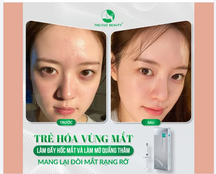 Thức khuya, căng thẳng hay sự thiếu hụt collagen tự nhiên khiến vùng hốc mắt trũng sâu, quầng thâm lộ rõ làm gương mặt trở nên lờ đờ, già nua.