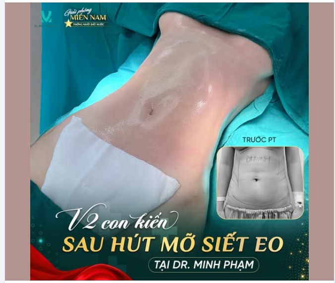 V2 “CON KIẾN” SAU HÚT MỠ SIẾT EO