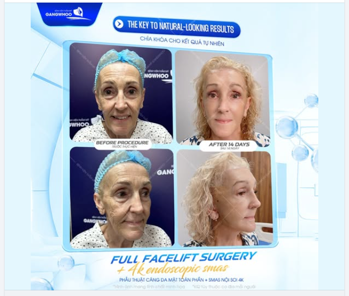 Tại Bệnh viện thẩm mỹ Gangwhoo, chìa khóa đó chính là: Phẫu thuật căng da mặt toàn phần + SMAS nội soi 4K: