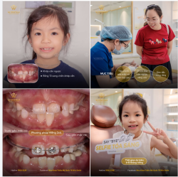 NIỀNG RĂNG 2x4 - MÓN QUÀ NHỎ, Ý NGHĨA LỚN CHO NỤ CƯỜI CỦA CON